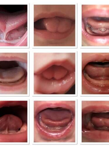 Überweisung für Frenotomie